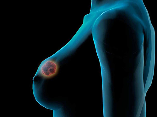 khối u ở vú gây lo ra mối lo ung thư vú ở phụ nữ
